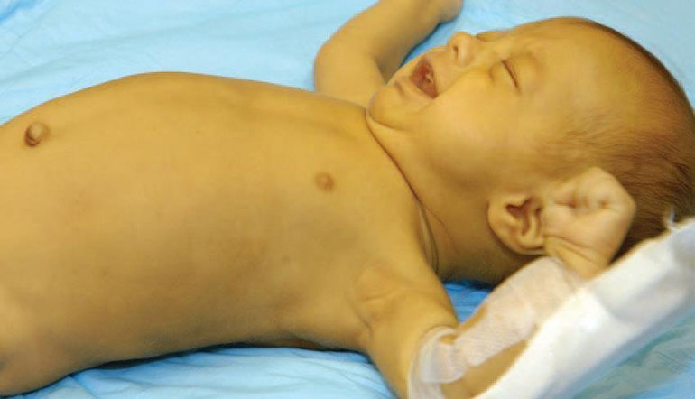 Фототерапия при желтухе новорожденных