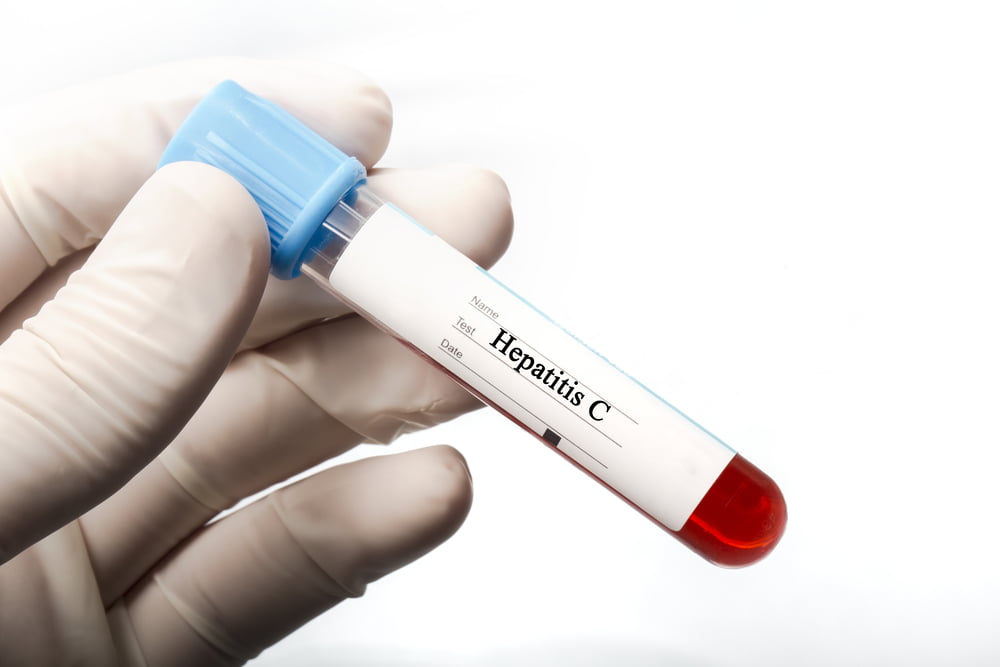Ложноположительный анализ на гепатит С