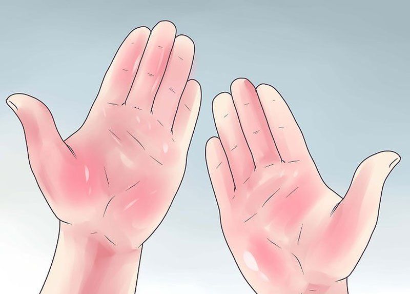 Краснеют ладони рук при гепатите thumbnail