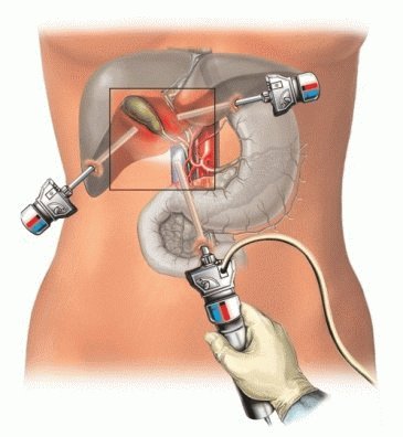 Эндоскопическая операция удаление камней из желчного пузыря thumbnail